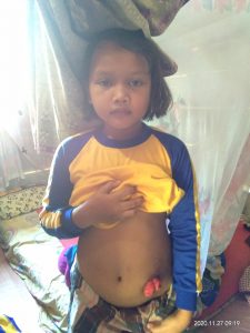 Lusi Oktavia Ristiana Gadis Cilik Tanpa Anus Butuh Bantuan