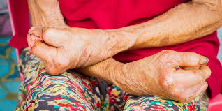 Dinas Kesehatan Baubau Mewaspadai Peningkatan Penyakit Kusta